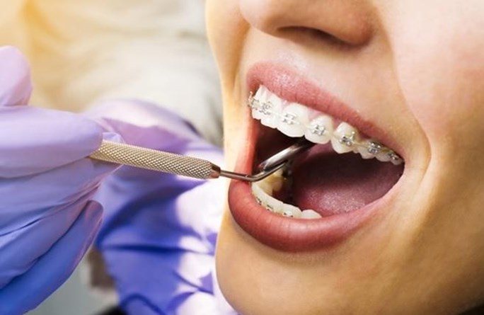 aparat dentar