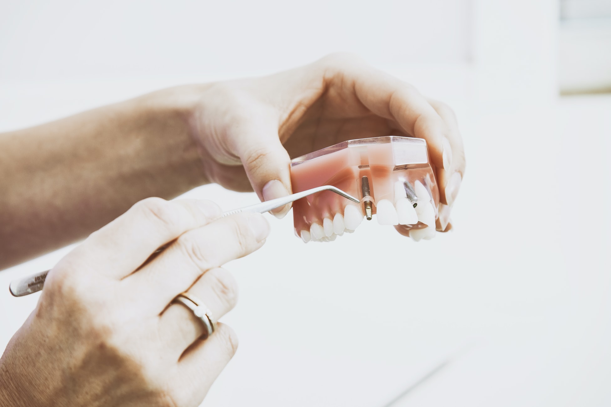 Implanturi dentare imediate